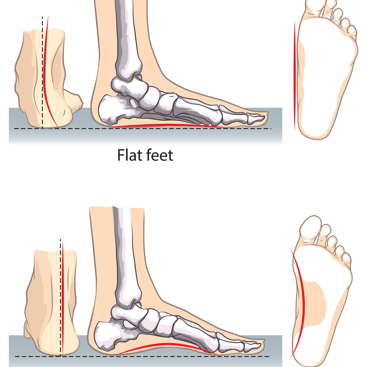 Foot Alignment and Orthotics – Pedicurian