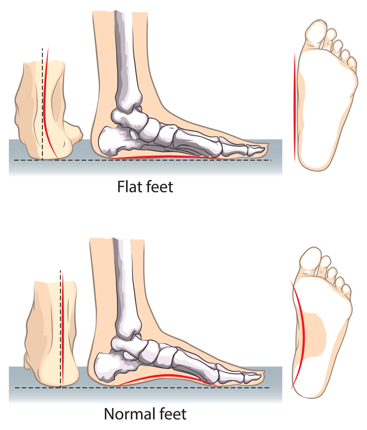 Foot Alignment and Orthotics – Pedicurian