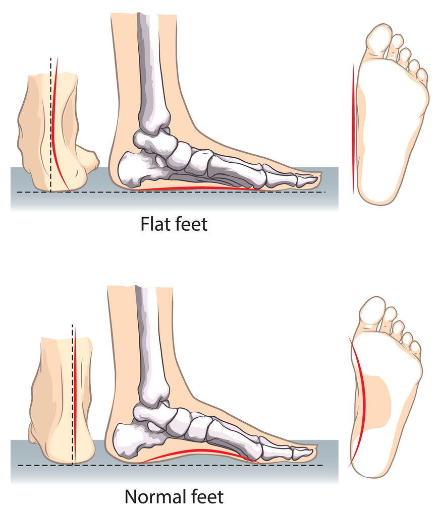 Foot Alignment and Orthotics