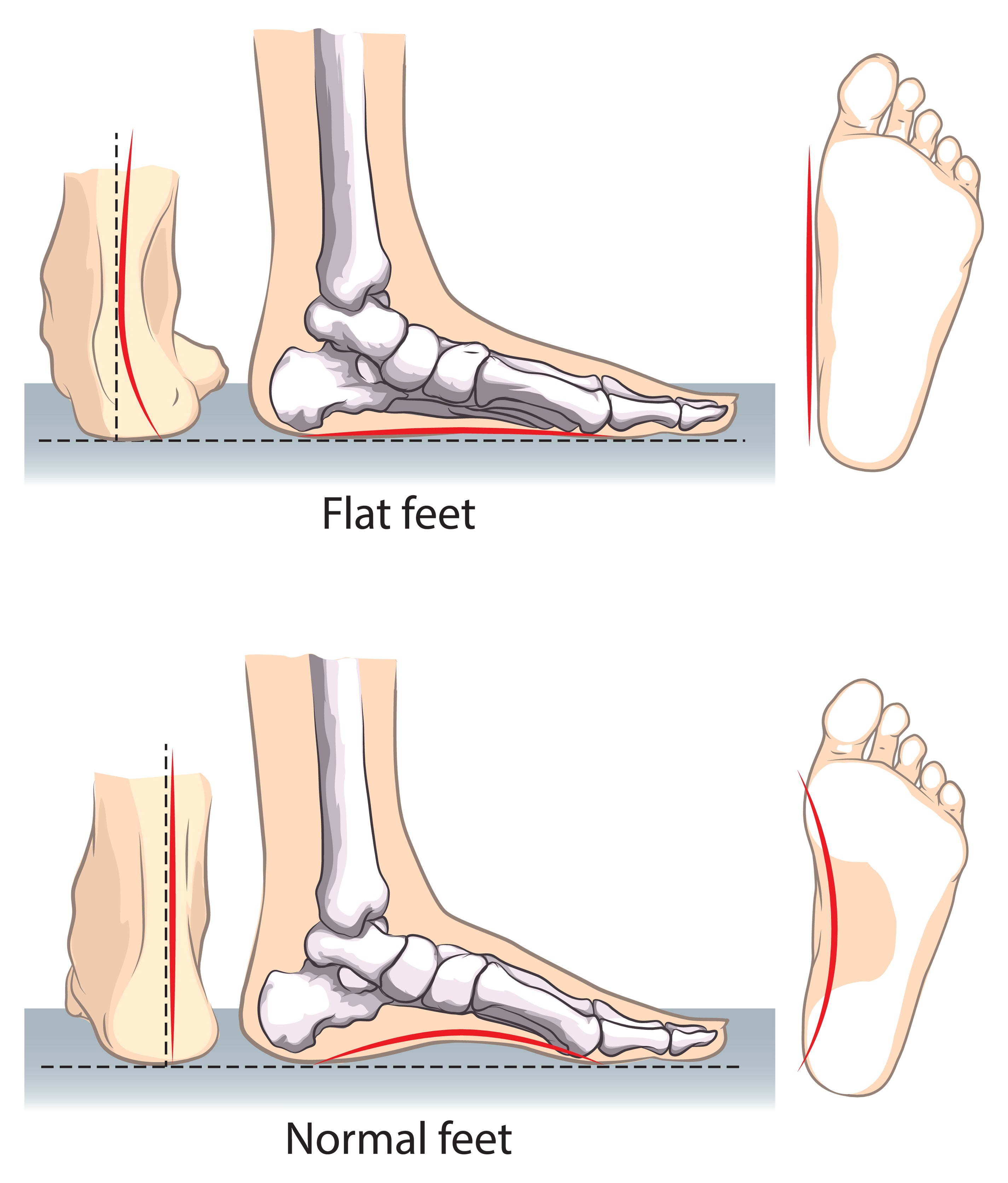 Best otc orthotics for flat clearance feet