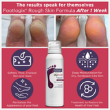 Footlogix® Cream Mousse Rough Skin Formula